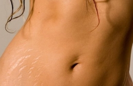 質問の多かった！妊娠線があっても働けますか？について